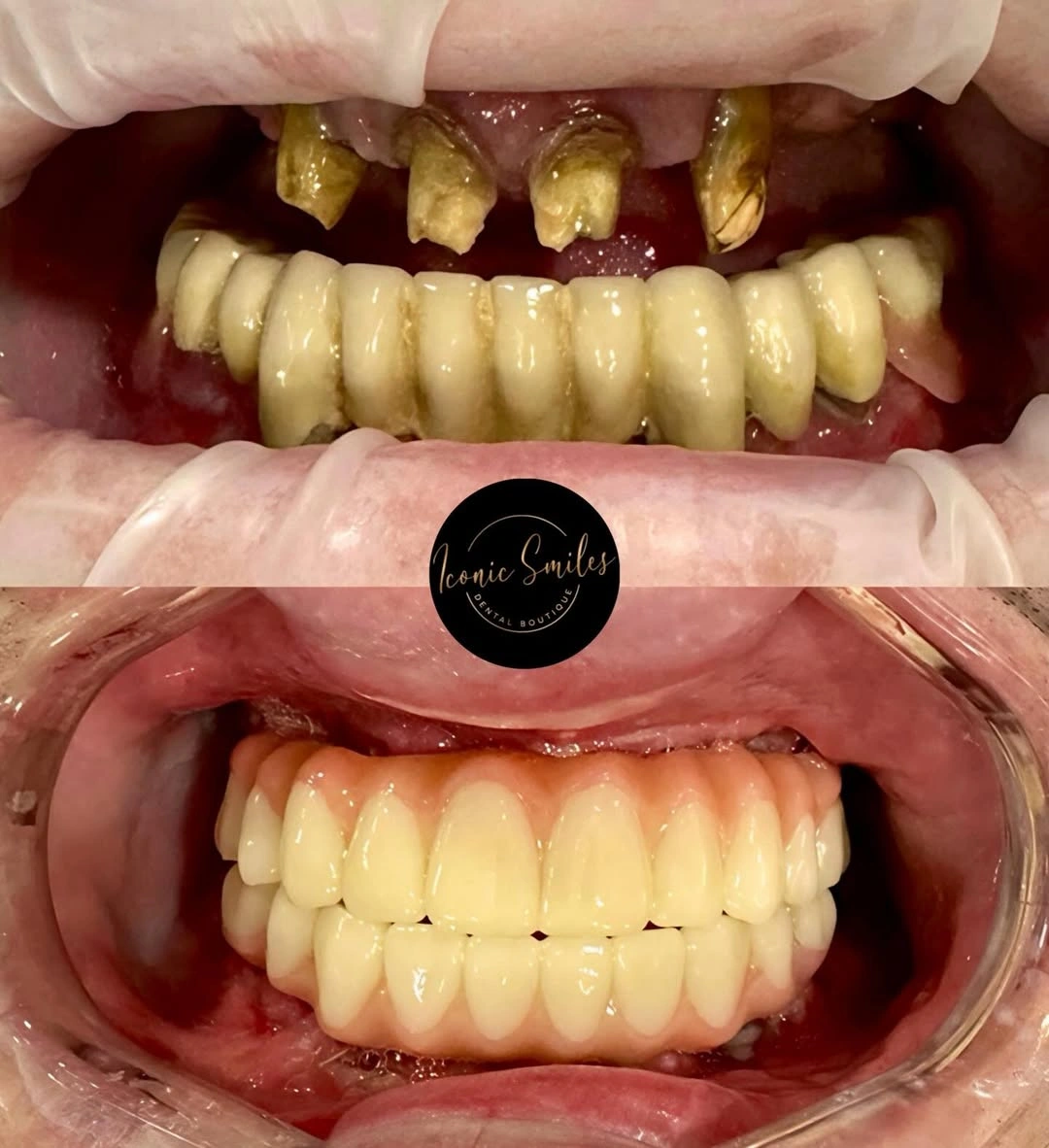 Published before and after full-arch clinical case from Iconic Smiles