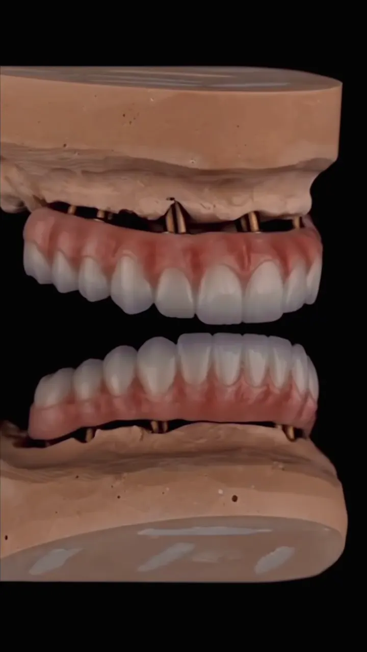 Full-arch implant restoration planning