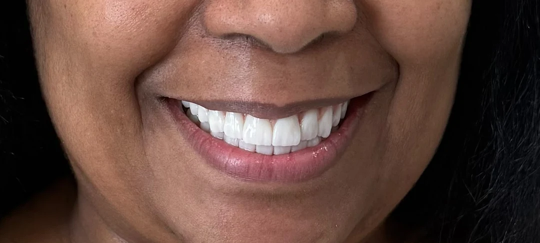 The same patient after treatment: a complete, even upper arch