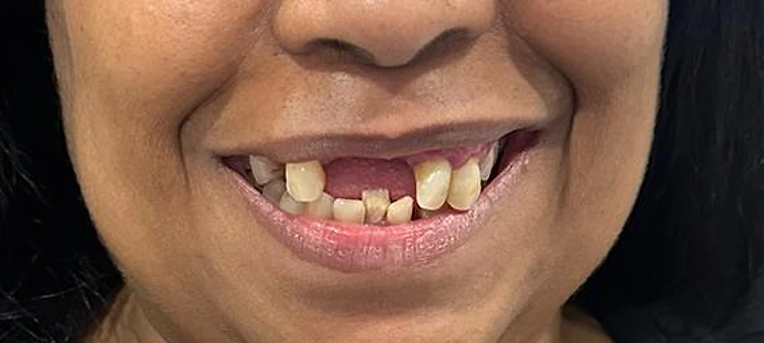 A patient of Iconic Smiles before treatment: several upper front teeth are missing or broken